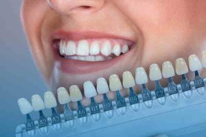 ציפויי שיניים בירושלים