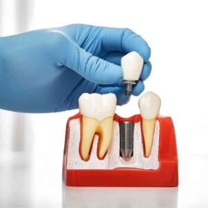 השתלות שיניים