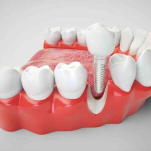 השתלת שיניים למחוסרי עצם