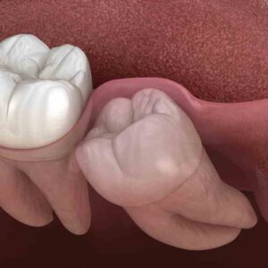 עקירת שיני בינה