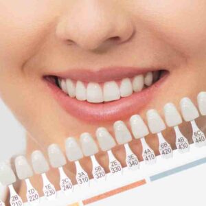 ציפויי שיניים