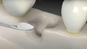 השתלת שיניים לחולי אוסטיאופורוזוס