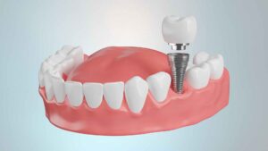 השתלת שתל בודד