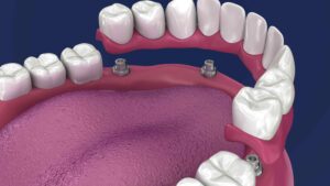 השתלת שיניים בלסת תחתונה