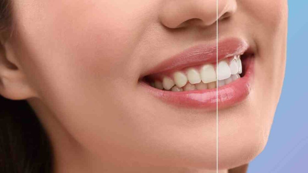 סוגי ציפויי שיניים