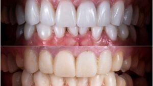 ציפויי חרסינה לפני אחרי